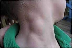 Secara khususnya lymphatic system terdiri dari 3 unsur iaitu Punca Faktor Dan Panduan Lengkap Mengenai Kanser Limfoma