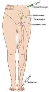 Pin On Lymphedema Lymphatic System