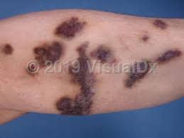It appears as red or purple patches on the skin, mouth, lungs, liver, or digestive system. Aids Associated Kaposi Sarcoma