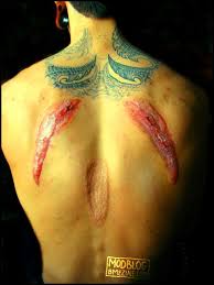 Big Skin Removal Scars Bme Tattoo Piercing And Body Modification News