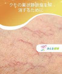 クモの巣状静脈瘤を解消するために みんな健康 静脈瘤 血管 若返り 自然療法
