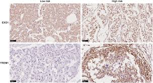 An immunohistochemical marker that is both sensitive and specific for malignant mesothelioma remains elusive. Development And Validation Of A Tp53 Associated Immune Prognostic Model For Hepatocellular Carcinoma Ebiomedicine