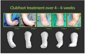 Image result for Clubfoot