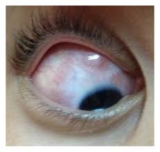 Image result for lesion sclera