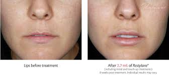 New filler gives lips a more subtle pout