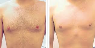 Because it works at the follicle level, it achieves permanent hair. Laser Hair Removal Before And After Photos Usha Rajagopal Md
