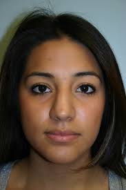 Maybe you would like to learn more about one of these? Rhinoplasty Houston Tx Nose Job Houston Dr Leo Lapuerta