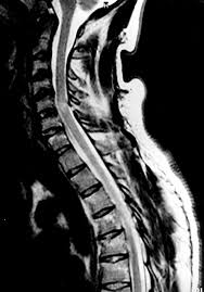 A Case Of Brown Sequard Syndrome With Associated Horner S Syndrome After Blunt Injury To The Cervical Spine Emergency Medicine Journal