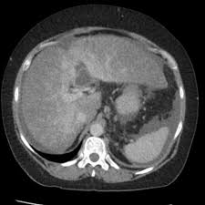 Budd Chiari Syndrome In A Patient With Chronic Alcoholic Cirrhosis Eurorad