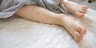 Image result for bedbug bites look like