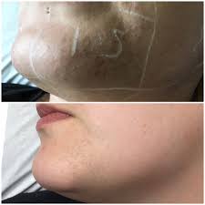 The no no hair removal device cost less than laser removal treatments and is slim and portable which means you can do a hair removal treatment anytime this allows you to use the no!no! Laser Hair Removal Results Our Richmond House Beauty Facebook