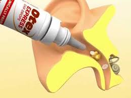 This procedure should be repeated once or twice daily while your symptoms clear. How To Melt Ear Wax With Otex Melting Earwax With Otex Otex Ear Wax Product Review Youtube