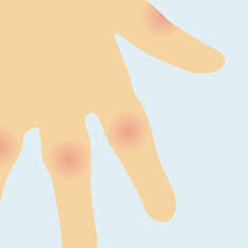 Check spelling or type a new query. Rheumatoid Nodules In Rheumatoid Arthritis Ra Nras