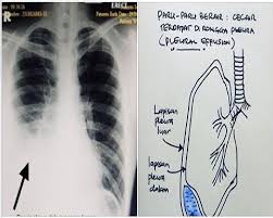 Bisa dibilang, kondisi ini bukanlah penyakit, tetapi perwujudan dari beberapa penyakit paru yang mungkin menyerang anda. Paru Paru Berair Sebab Mandi Malam Baca Ulasan Doktor Pakar Raspirotori My Info Maya