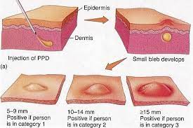 The preferred site of the test is the volar aspect of the forearm. Pin On Tuberculin Skin Test Mantoux Test For Tb