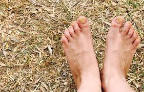 Image result for Yellow nail syndrome feet
