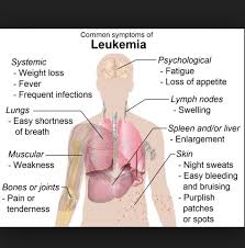 Symptoms Leukemia Treatment Leukemia Symptoms Oncology Nursing