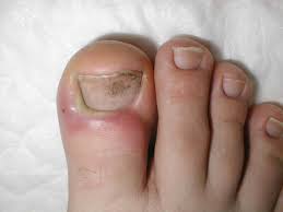 Image result for Paronychia feet