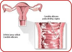 Maybe you would like to learn more about one of these? Apa Penyebab Keputihan Pada Wanita Hamil Bagaimana Cara Mengatasinya Tokoalkes Com Tokoalkes Com