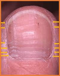 Image result for Beau lines feet