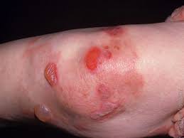 Image result for Pemphigoid