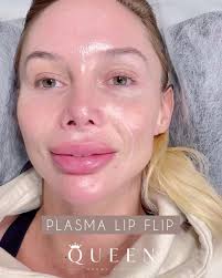 Plasma Lip Flip 👄, The Lip Flip is...