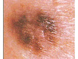 Et depuis que je suis ici, tous les hivers j'ai la peau qui démange quand je stresse, j'ai une émotion forte ou bien quand je fais de l'effort physique. Naevus Dysplasiques Et Risque De Melanome The Skin Cancer Foundation