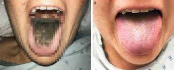 Image result for black tongue symptoms