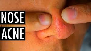 Dies sind die ergänzungen, die sie mündlich durchführen. How To Get Rid Of Nose Pimples Remove Pimples On Nose Tiege Hanley Youtube