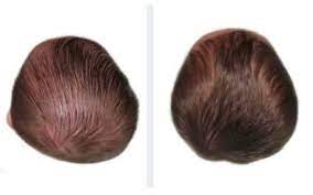 Helmet therapy results - before and after treatment