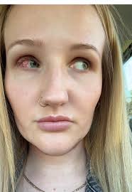 Transforming Confidence: 6 Weeks Post Strabismus Surgery