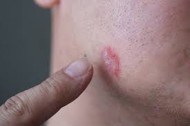 Image result for psoriasis