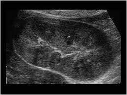 Pyelonephritis Of The Right Kidney With An Edematous Swollen Slightly Hyperechoic Right Kidney Sonography Ultrasound Renal