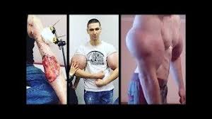 Synthol Biceps Explodes Youtube Synthol abuse can turn muscle into rock, potentially leading to amputations. synthol biceps explodes youtube
