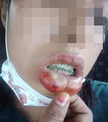 Caj sediada rawatan pergigian pesakit luar (warganegara) di fasiliti kementerian kesihatan kekal. M Sian Girl Allegedly Suffered High Fever Swollen Lips With Pus After Getting S 63 Braces To Be Trendy Mothership Sg News From Singapore Asia And Around The World