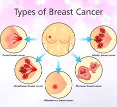 Inflammatory breast cancer is an uncommon form of breast cancer which spreads fast and affects the signs and symptoms of inflammatory breast cancer are: Asha Krishnan Author At Dr V Ashwin Karuppan