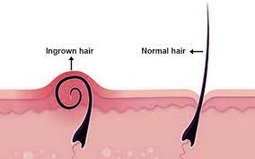 It typically forms as a lump or sore on the vulva, often causing itching. Is It Skin Cancer Or Just An Ingrown Hair Molemap Australia