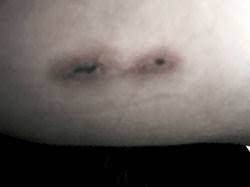 Surface Piercings Rejection Shameless Body Jewels It was definately the most painful piercing i've ever gotten. surface piercings rejection shameless