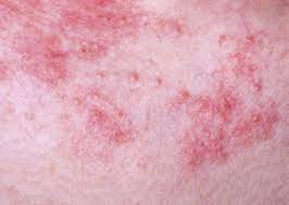 Hay Fever Rash Fever Rash Hay Fever Rashes