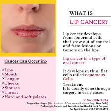 Image result for Lip Cancer