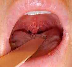 Was Ist Herpes Osophagitis Herpes Im Hals