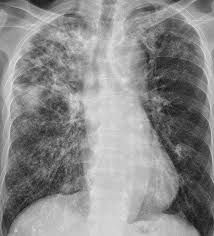 Post Tb Fibrosis More Likely As There S A Prominent Tracheal Pull To The Right However Active Koch S Cannot Be R Radiology Imaging Pulmonology Radiology