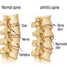 Five Main Causes Of Spinal Arthritis Spinal Arthritis Arthritis Symptoms Rheumatoid Arthritis Symptoms