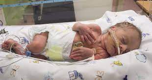 Punca sebenarnya masih belum dikenal pasti. Fahami Tentang Bayi Pramatang Risiko Kesihatan Ini Sebabnya Mereka Perlu Terus Dipantau Pa Ma