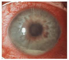 Image result for Hyphema