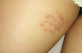 Most hpv infections don't lead to cancer. Herpes Vs Hpv How Are They Different Doctors In Italy