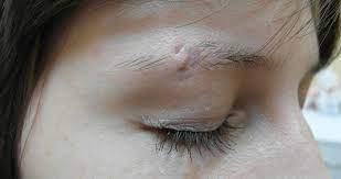 Eyebrow Piercing Scars Treatment And Prevention Authoritytattoo