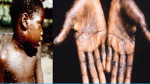 Monkeypox is a rare, infectious disease that is caused by the monkeypox virus. What Is Monkeypox Is It Contagious How Dangerous Is This Rare Zoonotic Viral Disease Found In Uk Oneindia News
