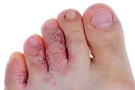 Image result for mykoza nehtů