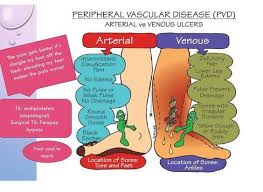 Clinical Manifestations Of Pvd Graphic Showing Arterial Vs